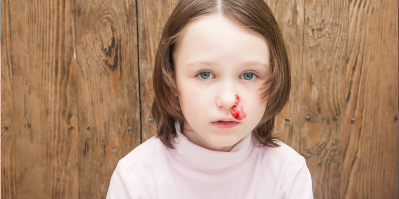 Sangue dal naso bambini rimedi naturali